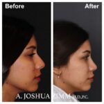 Rhinoplasty - before and after