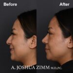 Rhinoplasty - before and after