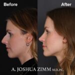 Rhinoplasty - before and after