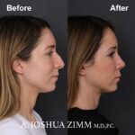 Rhinoplasty - before and after