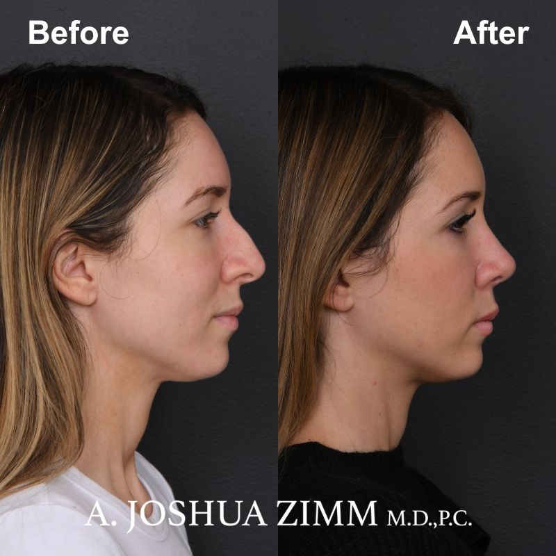 Rhinoplasty - before and after