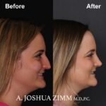 Rhinoplasty - before and after