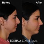 Chin implant - before and after