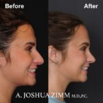 Rhinoplasty - before and after