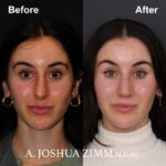 Rhinoplasty - before and after