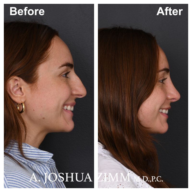 Rhinoplasty - before and after