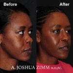 Rhinoplasty - before and after