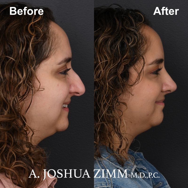 Rhinoplasty - before and after