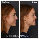 Rhinoplasty - before and after