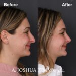 Rhinoplasty - before and after