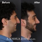 Rhinoplasty - before and after