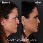 Rhinoplasty - before and after