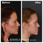 Rhinoplasty - before and after