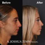 Rhinoplasty - before and after