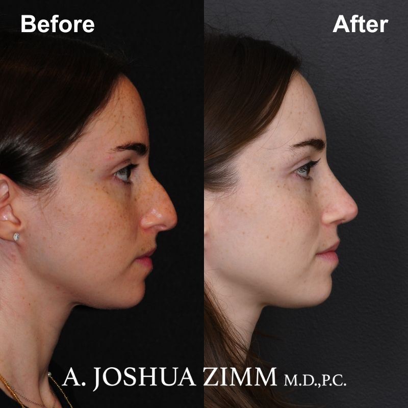 Rhinoplasty - before and after