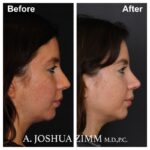 Rhinoplasty - before and after