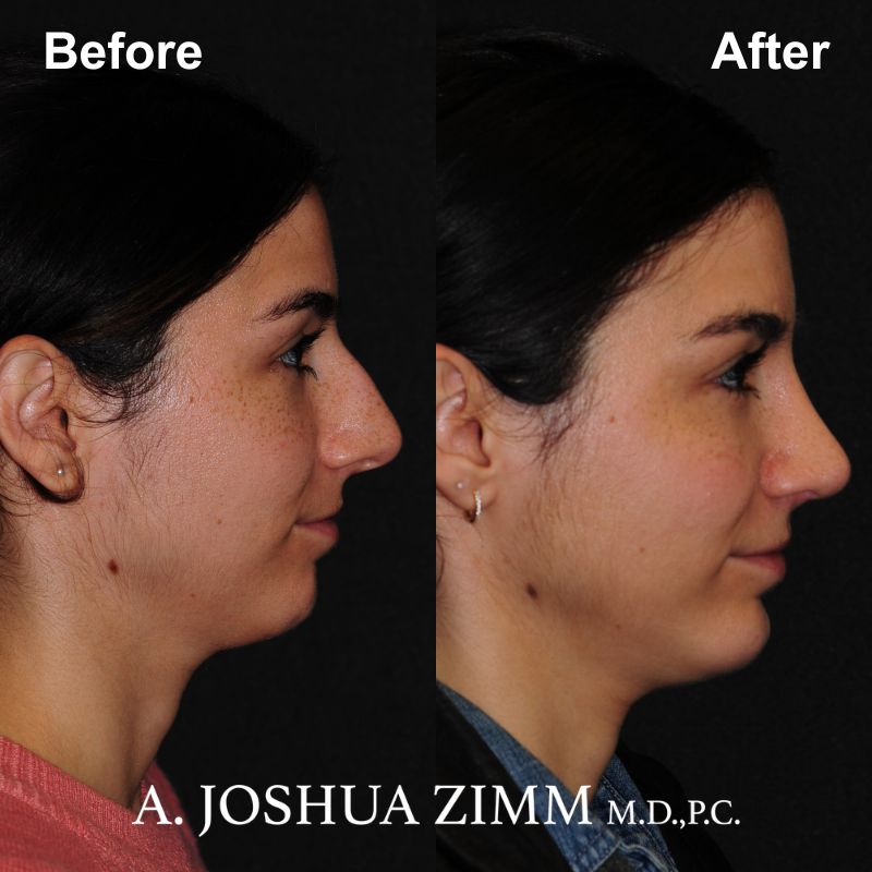 Rhinoplasty - before and after