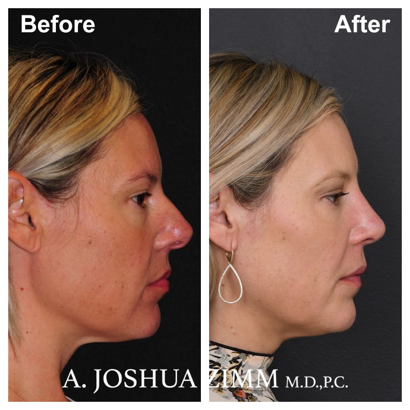 Rhinoplasty - before and after