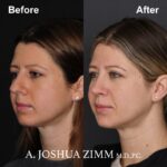 Rhinoplasty - before and after