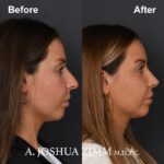 Rhinoplasty - before and after