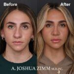 Rhinoplasty - before and after