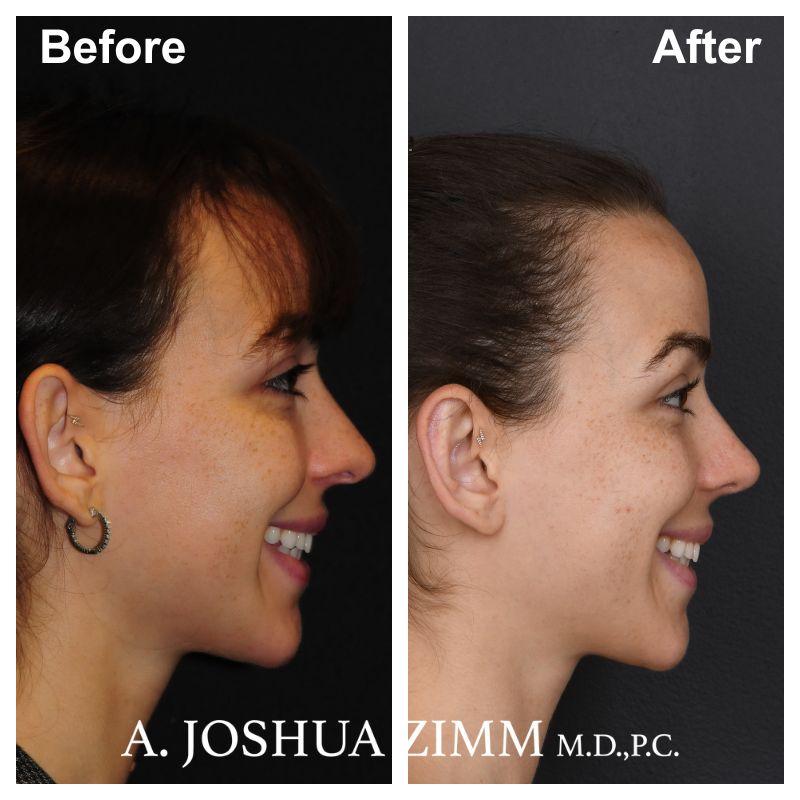 Rhinoplasty - before and after