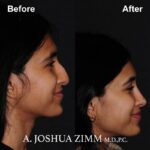 Rhinoplasty - before and after