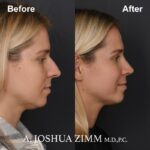 Rhinoplasty - before and after