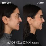 Rhinoplasty - before and after