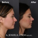 Rhinoplasty - before and after