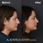 Rhinoplasty - before and after