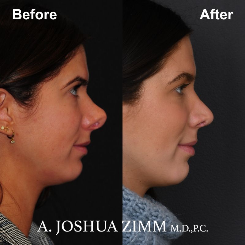 Rhinoplasty - before and after