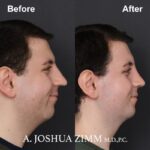 Rhinoplasty - before and after