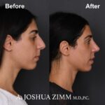 Rhinoplasty - before and after