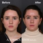 Rhinoplasty - before and after