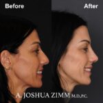 Rhinoplasty - before and after