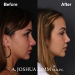 Rhinoplasty - before and after