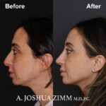 Rhinoplasty - before and after