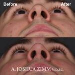 Rhinoplasty - before and after