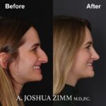 Rhinoplasty - before and after