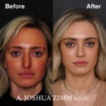 Rhinoplasty - before and after