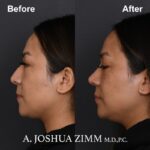 Rhinoplasty - before and after