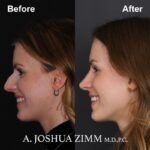 Rhinoplasty - before and after