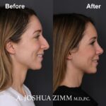 Rhinoplasty - before and after