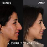 Rhinoplasty - before and after