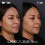 Rhinoplasty - before and after