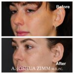 Rhinoplasty - before and after