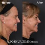 Rhinoplasty - before and after