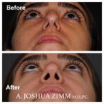 Rhinoplasty - before and after