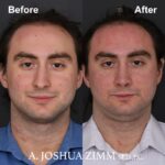 Rhinoplasty - before and after